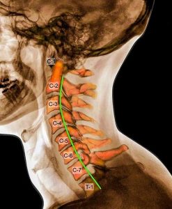a nyaki régió akut osteochondrosisa éles fájdalom a hát bal oldalán